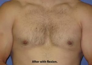 Gynecomastia Before & After Patient #1359