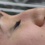 Non-Surgical Rhinoplasty Before & After Patient #798