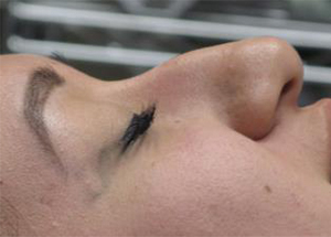 Non-Surgical Rhinoplasty Before & After Patient #798