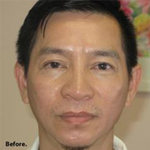 Non-Surgical Rhinoplasty Before & After Patient #814