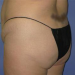 Brazilian Butt Lift Before & After Patient #7345