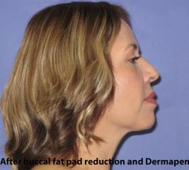 Micro-needling Before & After Patient #1082