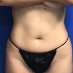 VASER Liposuction Hi-Def Before & After Patient #7266