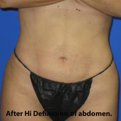 VASER Liposuction Before & After Patient #65