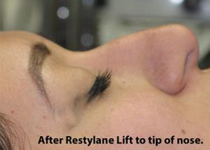 Non-Surgical Rhinoplasty Before & After Patient #798