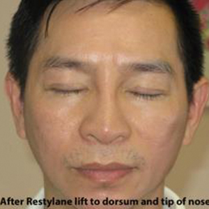 Non-Surgical Rhinoplasty Before & After Patient #814