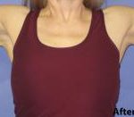 Arm Lift (Brachioplasty) Before & After Patient #1423