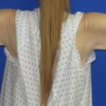 Arm Lift (Brachioplasty) Before & After Patient #1423