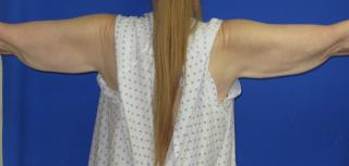 Arm Lift (Brachioplasty) Before & After Patient #1423