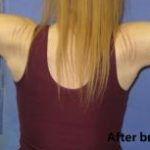 Arm Lift (Brachioplasty) Before & After Patient #1423