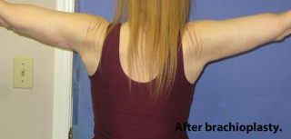 Arm Lift (Brachioplasty) Before & After Patient #1423