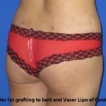 VASER Liposuction Before & After Patient #259