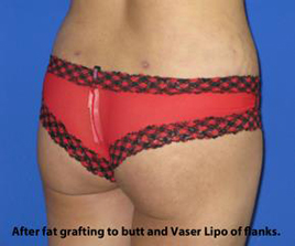 VASER Liposuction Before & After Patient #259