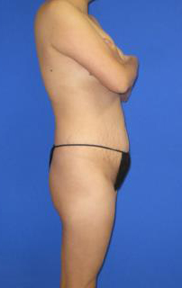 VASER Liposuction Before & After Patient #7340