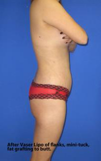 VASER Liposuction Before & After Patient #7340