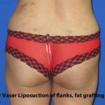 VASER Liposuction Before & After Patient #259