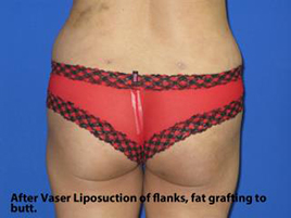 VASER Liposuction Before & After Patient #259