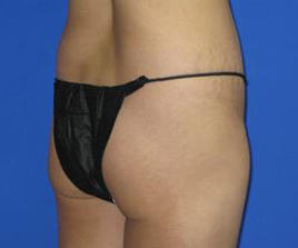 VASER Liposuction Before & After Patient #259