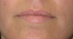 Lips Before & After Patient #735