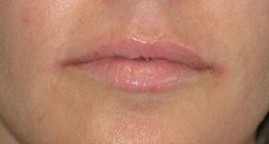 Lips Before & After Patient #735