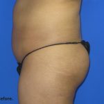 VASER Liposuction Before & After Patient #134