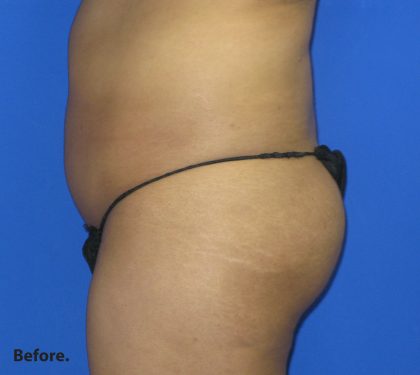 VASER Liposuction Before & After Patient #134