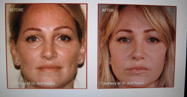 PRF Filler Before and After 01