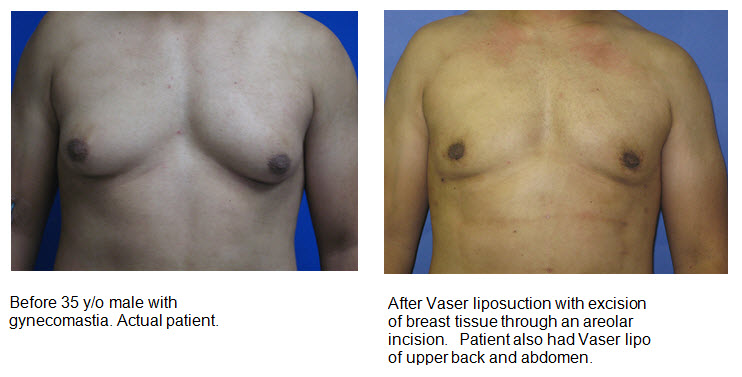 Gynecomastia Portland