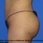 VASER Liposuction Before & After Patient #134