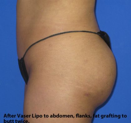 VASER Liposuction Before & After Patient #134