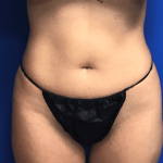 VASER Liposuction Hi-Def Before & After Patient #7942