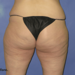 Fat Transfer Before & After Patient #7949