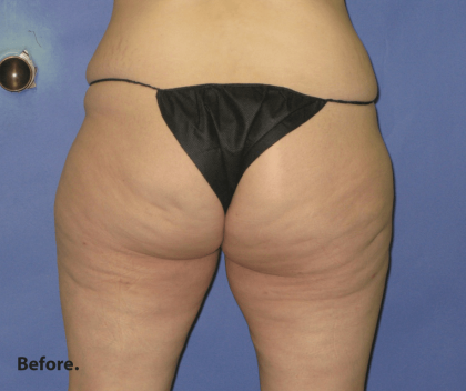 Fat Transfer Before & After Patient #7949