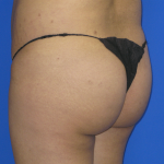 Brazilian Butt Lift Before & After Patient #7952