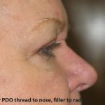 PDO Threads Before & After Patient #7970