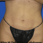 VASER Liposuction Hi-Def Before & After Patient #7942