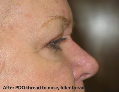 PDO Threads Before & After Patient #7970