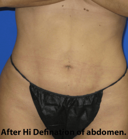 VASER Liposuction Hi-Def Before & After Patient #7942