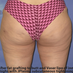 Fat Transfer Before & After Patient #7949