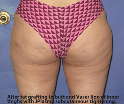 Fat Transfer Before & After Patient #7949