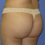 Brazilian Butt Lift Before & After Patient #7952