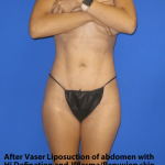 VASER Liposuction Hi-Def Before & After Patient #7957