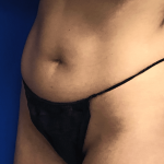 VASER Liposuction Hi-Def Before & After Patient #7942