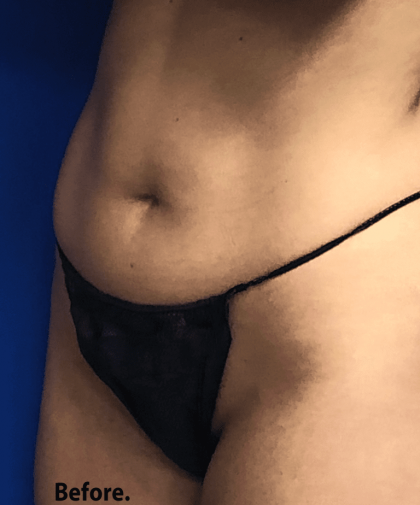 VASER Liposuction Hi-Def Before & After Patient #7942