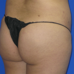 Brazilian Butt Lift Before & After Patient #7952