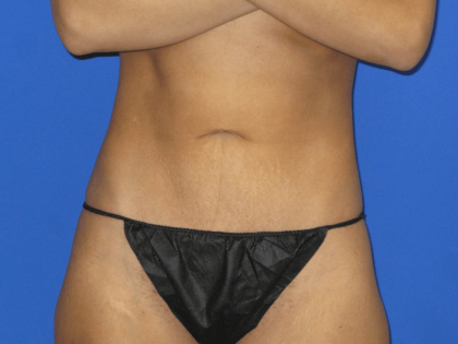 VASER Liposuction Hi-Def Before & After Patient #7957