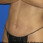 VASER Liposuction Hi-Def Before & After Patient #7942