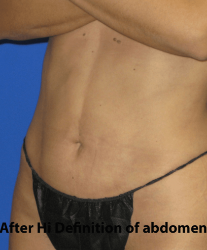 VASER Liposuction Hi-Def Before & After Patient #7942