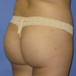 Brazilian Butt Lift Before & After Patient #7952