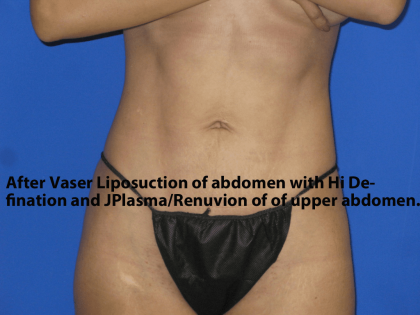 VASER Liposuction Hi-Def Before & After Patient #7957
